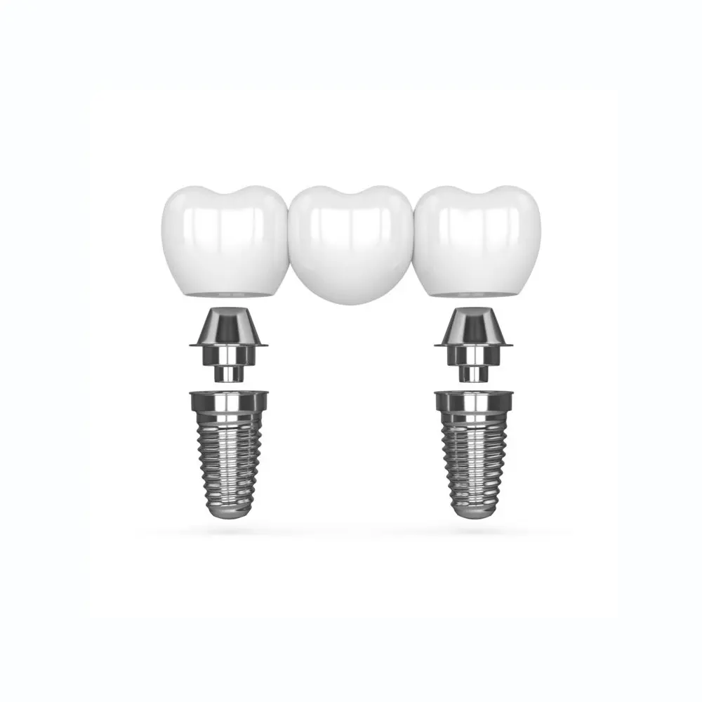 multi tooth implant bridge