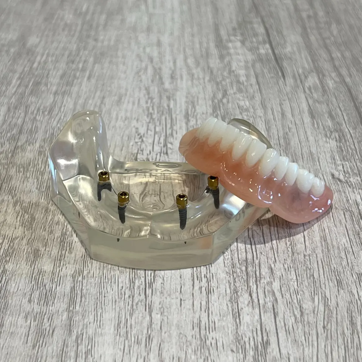 snap-in implant dentures