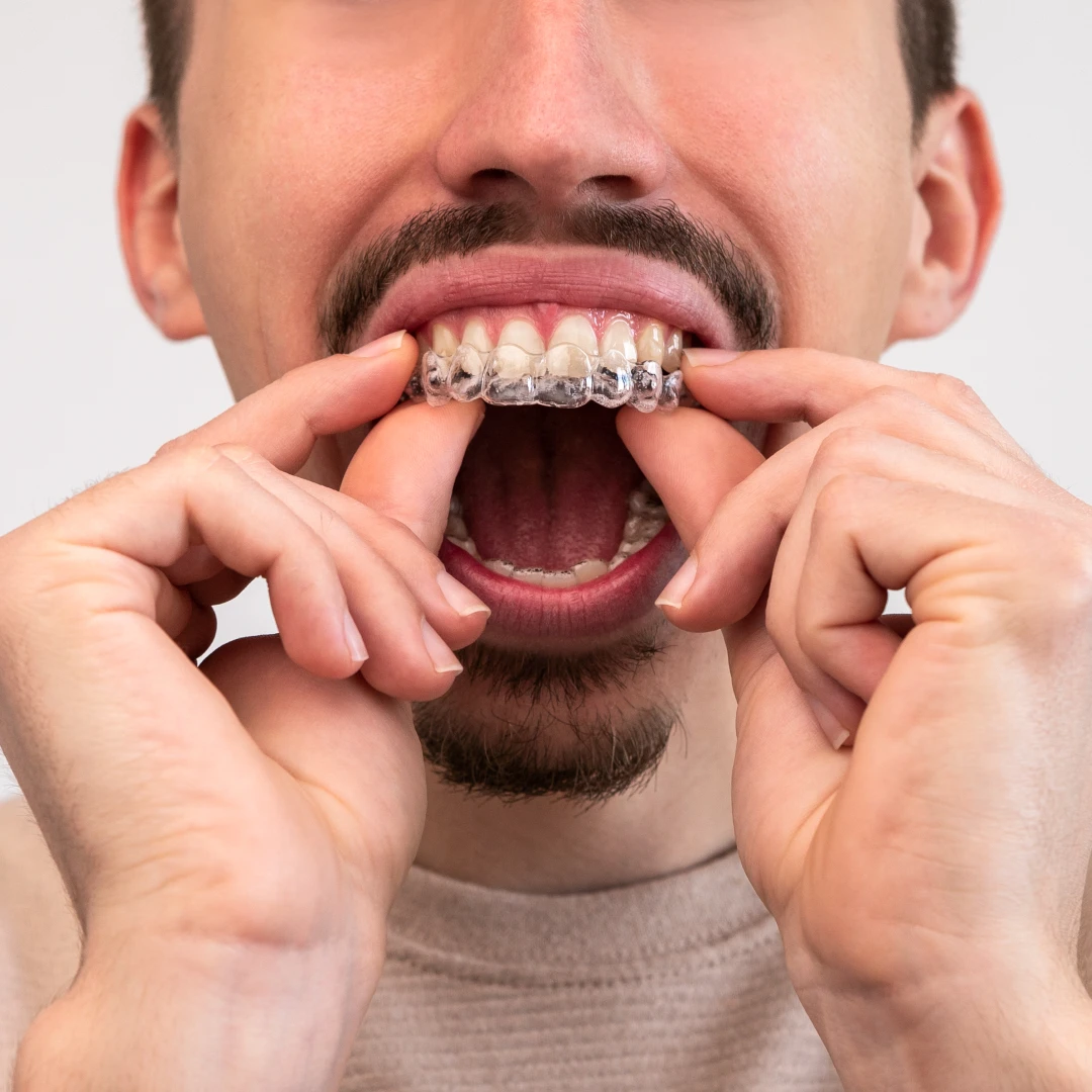 man putting on suresmile clear aligners to straighten teeth without braces